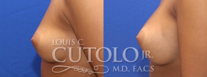 Before & After Breast Augmentation Case 5 View #4 View in Brooklyn, Staten Island, Queens, NY