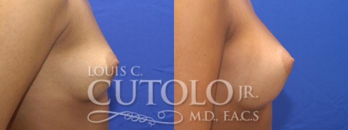 Before & After Breast Augmentation Case 5 View #5 View in Brooklyn, Staten Island, Queens, NY