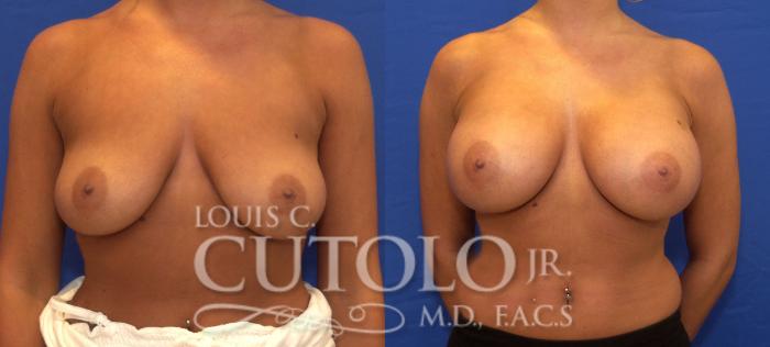 Before & After Breast Augmentation Case 54 View #1 View in Brooklyn, Staten Island, Queens, NY