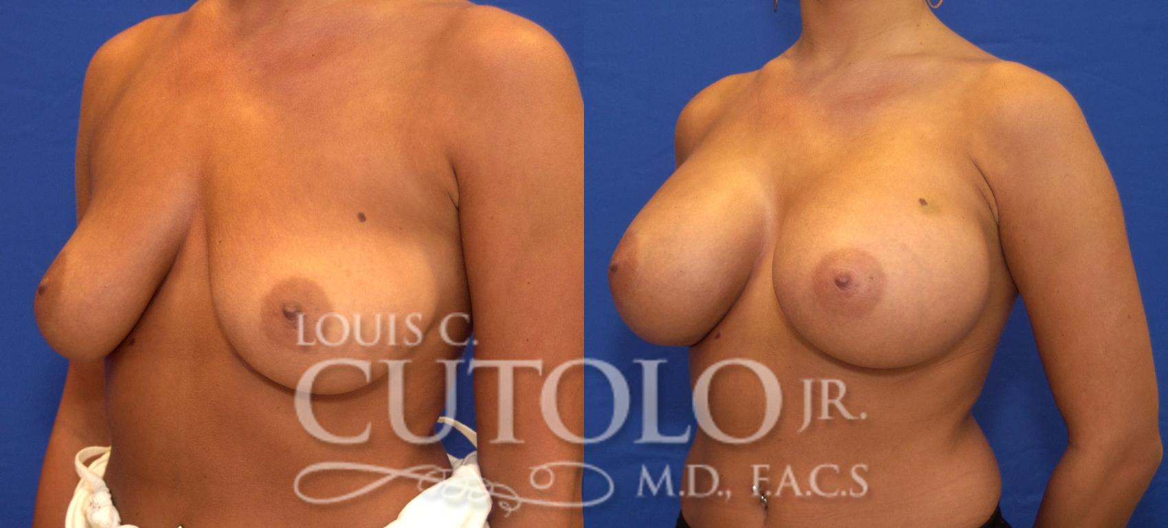 Before & After Breast Augmentation Case 54 View #2 View in Brooklyn, Staten Island, Queens, NY