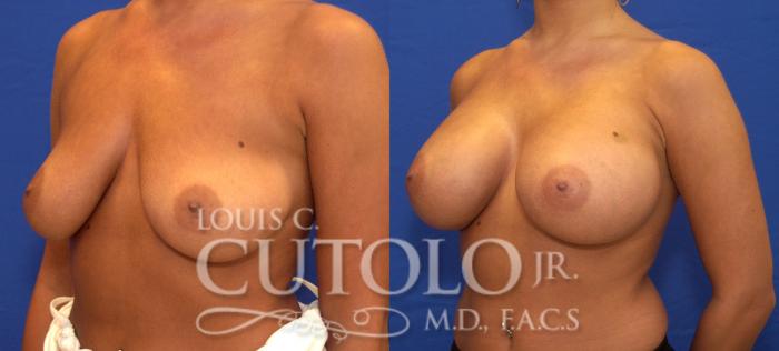 Before & After Breast Augmentation Case 54 View #2 View in Brooklyn, Staten Island, Queens, NY