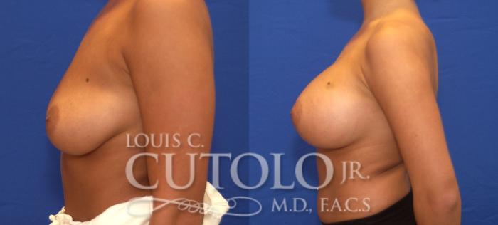 Before & After Breast Augmentation Case 54 View #3 View in Brooklyn, Staten Island, Queens, NY