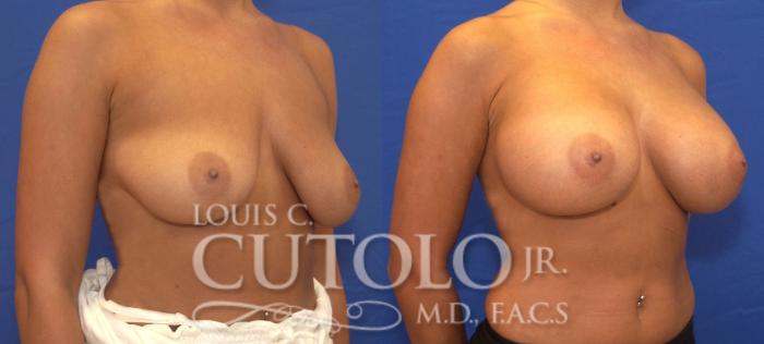 Before & After Breast Augmentation Case 54 View #4 View in Brooklyn, Staten Island, Queens, NY