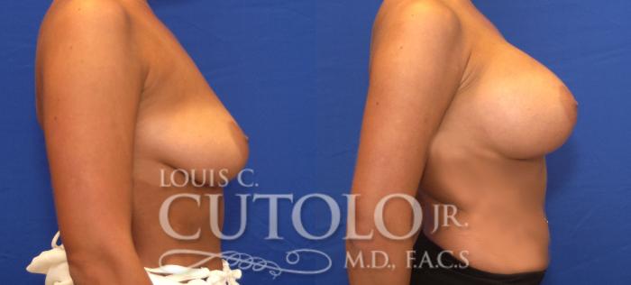 Before & After Breast Augmentation Case 54 View #5 View in Brooklyn, Staten Island, Queens, NY