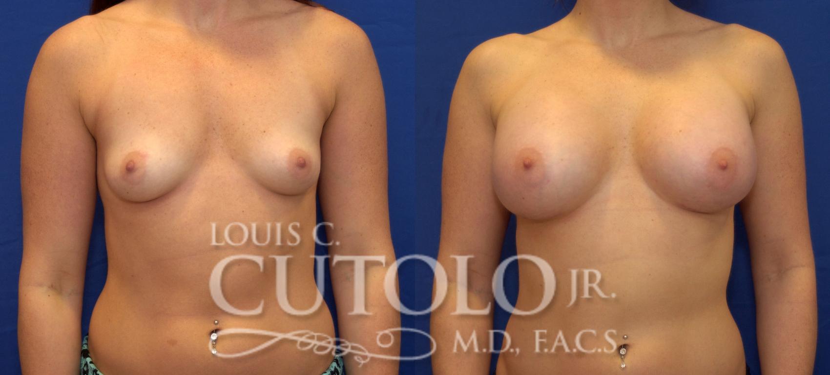 Before & After Breast Augmentation Case 59 View #1 View in Brooklyn, Staten Island, Queens, NY