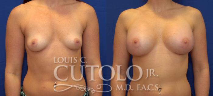 Before & After Breast Augmentation Case 59 View #1 View in Brooklyn, Staten Island, Queens, NY