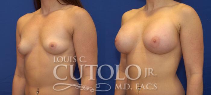 Before & After Breast Augmentation Case 59 View #2 View in Brooklyn, Staten Island, Queens, NY