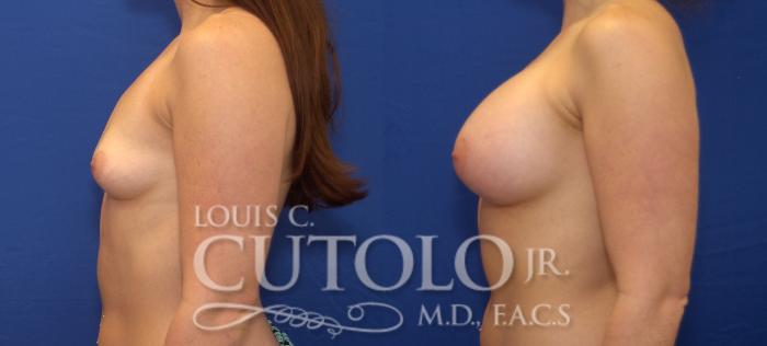 Before & After Breast Augmentation Case 59 View #3 View in Brooklyn, Staten Island, Queens, NY