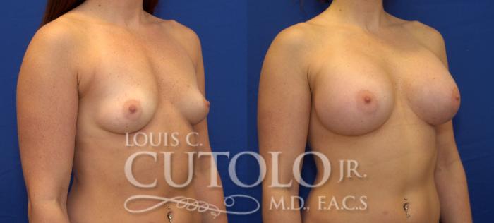 Before & After Breast Augmentation Case 59 View #4 View in Brooklyn, Staten Island, Queens, NY