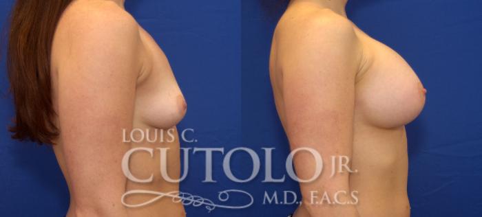 Before & After Breast Augmentation Case 59 View #5 View in Brooklyn, Staten Island, Queens, NY
