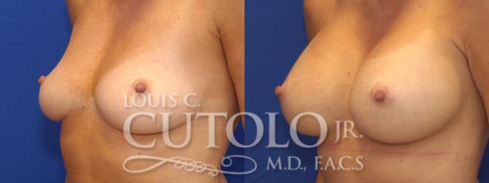 Before & After Breast Augmentation Case 6 View #2 View in Brooklyn, Staten Island, Queens, NY
