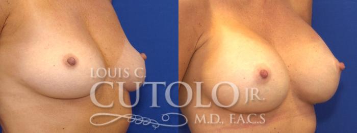 Before & After Breast Augmentation Case 6 View #3 View in Brooklyn, Staten Island, Queens, NY