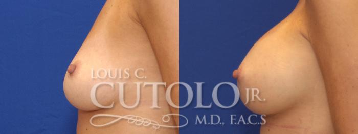 Before & After Breast Augmentation Case 6 View #4 View in Brooklyn, Staten Island, Queens, NY