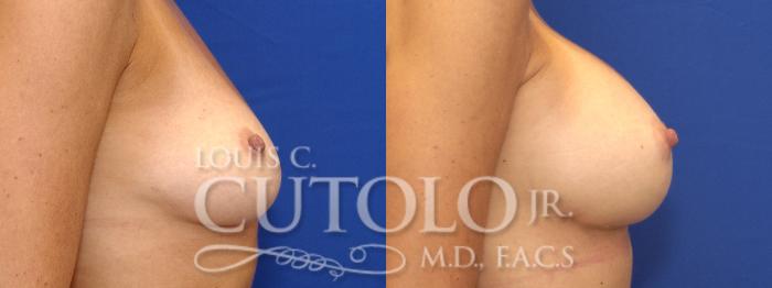 Before & After Breast Augmentation Case 6 View #5 View in Brooklyn, Staten Island, Queens, NY