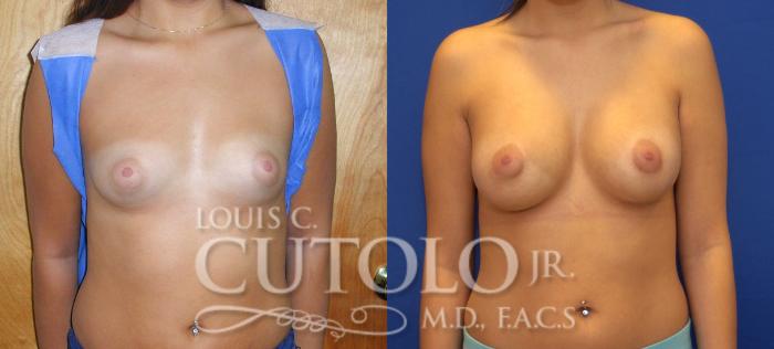 Before & After Breast Augmentation Case 60 View #1 View in Brooklyn, Staten Island, Queens, NY
