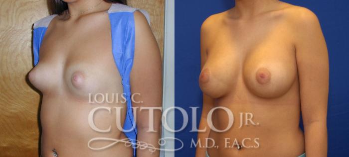 Before & After Breast Augmentation Case 60 View #2 View in Brooklyn, Staten Island, Queens, NY