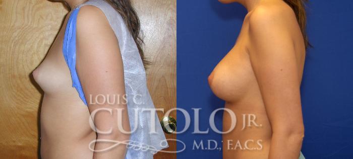 Before & After Breast Augmentation Case 60 View #3 View in Brooklyn, Staten Island, Queens, NY