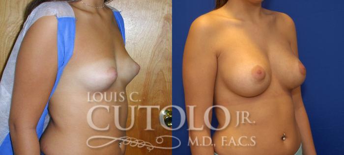 Before & After Breast Augmentation Case 60 View #4 View in Brooklyn, Staten Island, Queens, NY