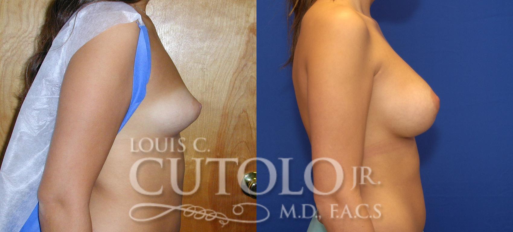 Before & After Breast Augmentation Case 60 View #5 View in Brooklyn, Staten Island, Queens, NY