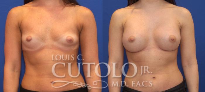 Before & After Breast Augmentation Case 63 View #1 View in Brooklyn, Staten Island, Queens, NY