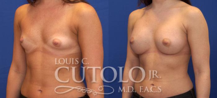 Before & After Breast Augmentation Case 63 View #2 View in Brooklyn, Staten Island, Queens, NY
