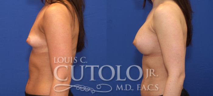 Before & After Breast Augmentation Case 63 View #3 View in Brooklyn, Staten Island, Queens, NY