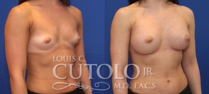Before & After Breast Augmentation Case 63 View #4 View in Brooklyn, Staten Island, Queens, NY