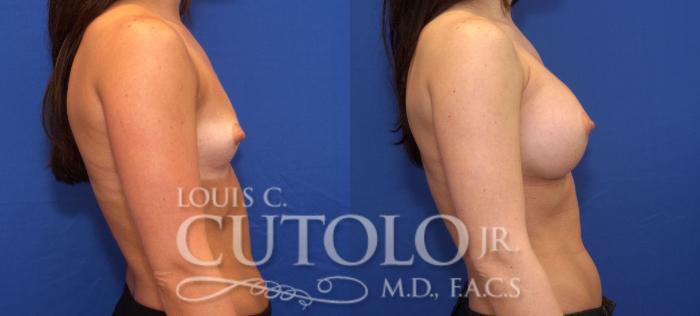 Before & After Breast Augmentation Case 63 View #5 View in Brooklyn, Staten Island, Queens, NY