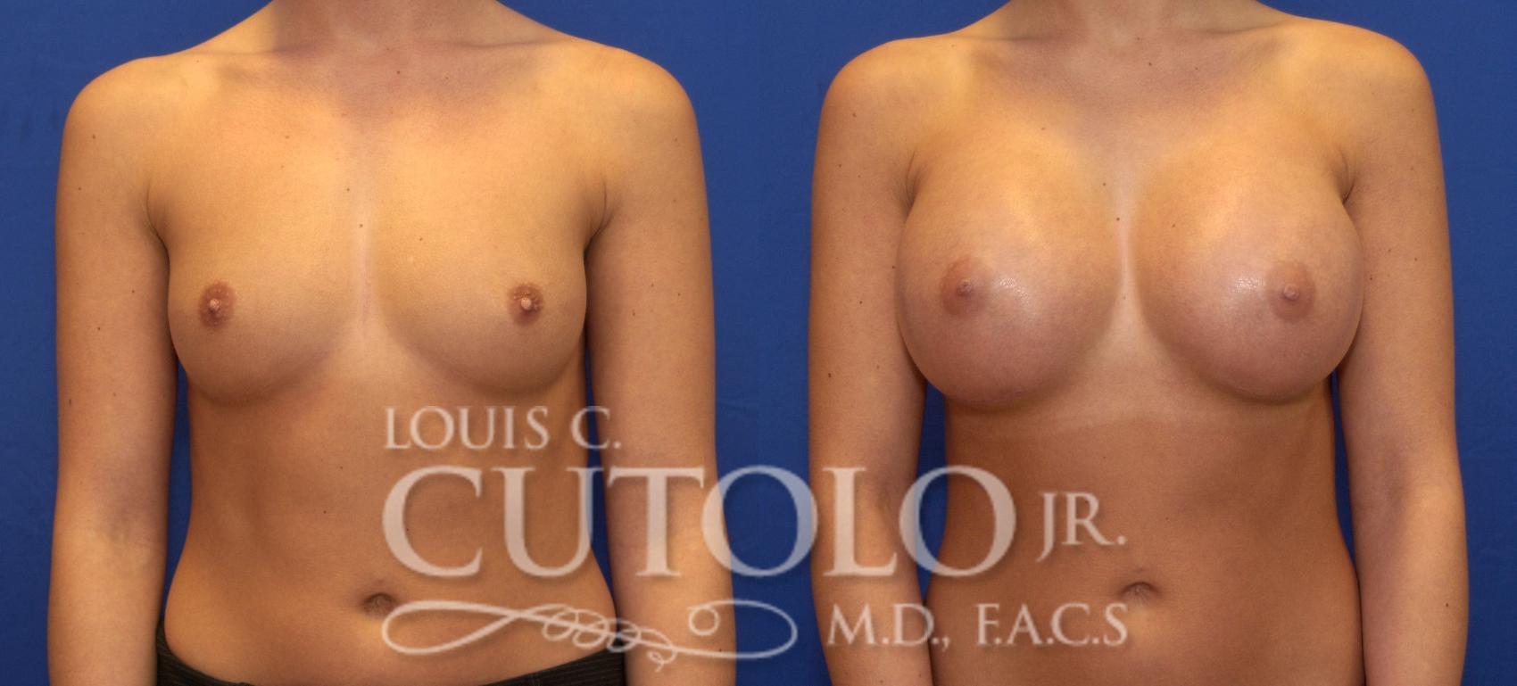 Before & After Breast Augmentation Case 64 View #1 View in Brooklyn, Staten Island, Queens, NY