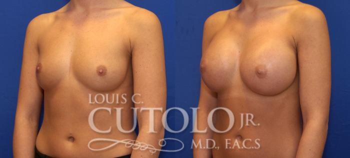 Before & After Breast Augmentation Case 64 View #2 View in Brooklyn, Staten Island, Queens, NY