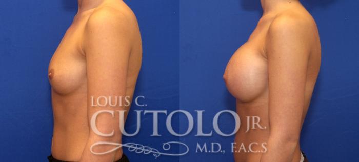 Before & After Breast Augmentation Case 64 View #3 View in Brooklyn, Staten Island, Queens, NY