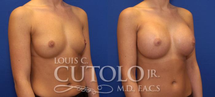 Before & After Breast Augmentation Case 64 View #4 View in Brooklyn, Staten Island, Queens, NY
