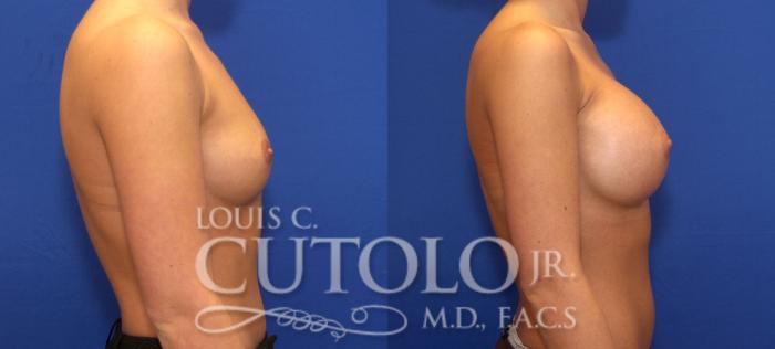 Before & After Breast Augmentation Case 64 View #5 View in Brooklyn, Staten Island, Queens, NY
