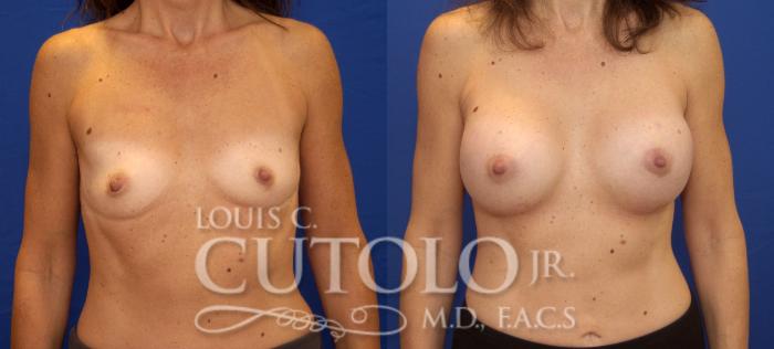 Before & After Breast Augmentation Case 65 View #1 View in Brooklyn, Staten Island, Queens, NY