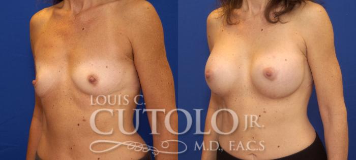 Before & After Breast Augmentation Case 65 View #2 View in Brooklyn, Staten Island, Queens, NY