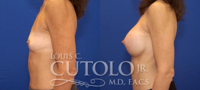 Before & After Breast Augmentation Case 65 View #3 View in Brooklyn, Staten Island, Queens, NY