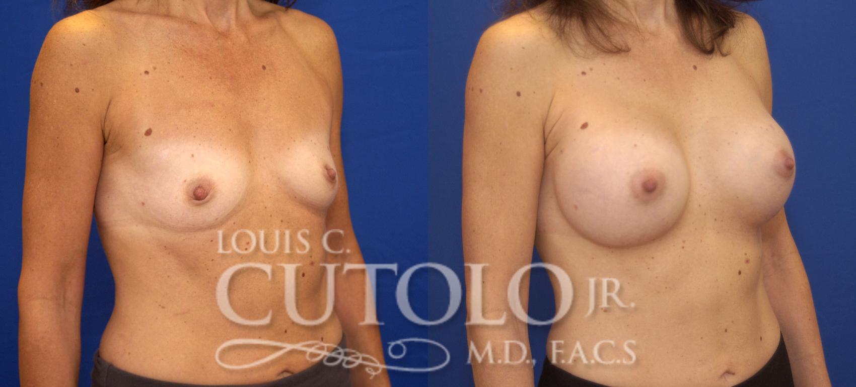 Before & After Breast Augmentation Case 65 View #4 View in Brooklyn, Staten Island, Queens, NY