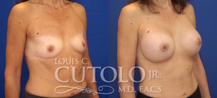 Before & After Breast Augmentation Case 65 View #4 View in Brooklyn, Staten Island, Queens, NY