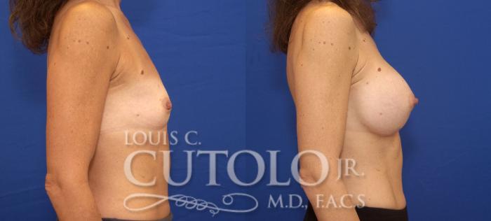 Before & After Breast Augmentation Case 65 View #5 View in Brooklyn, Staten Island, Queens, NY
