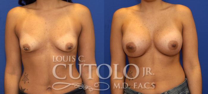 Before & After Breast Augmentation Case 66 View #1 View in Brooklyn, Staten Island, Queens, NY