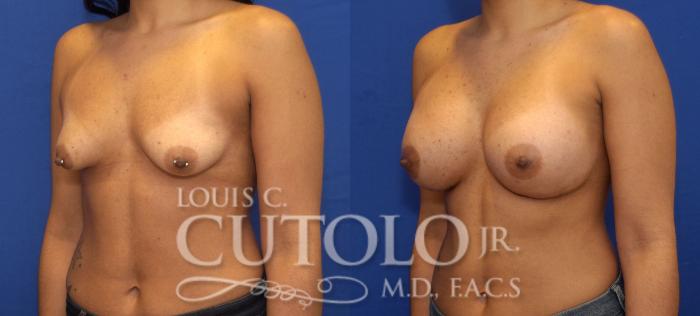 Before & After Breast Augmentation Case 66 View #2 View in Brooklyn, Staten Island, Queens, NY