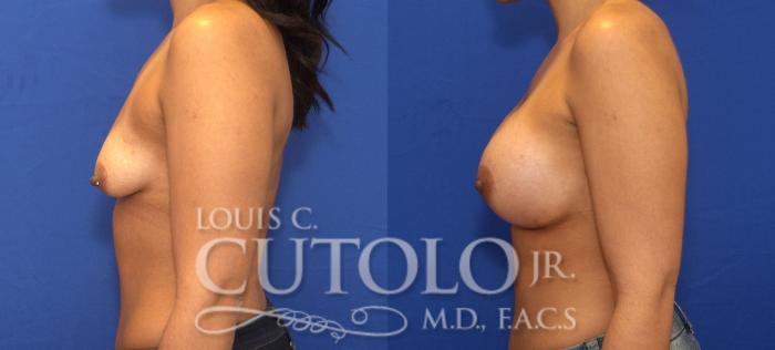 Before & After Breast Augmentation Case 66 View #3 View in Brooklyn, Staten Island, Queens, NY
