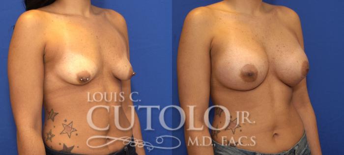 Before & After Breast Augmentation Case 66 View #4 View in Brooklyn, Staten Island, Queens, NY