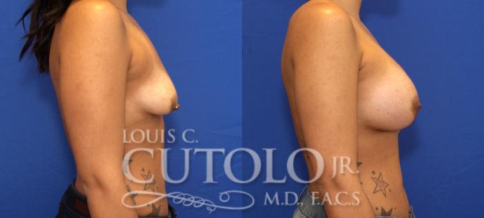 Before & After Breast Augmentation Case 66 View #5 View in Brooklyn, Staten Island, Queens, NY