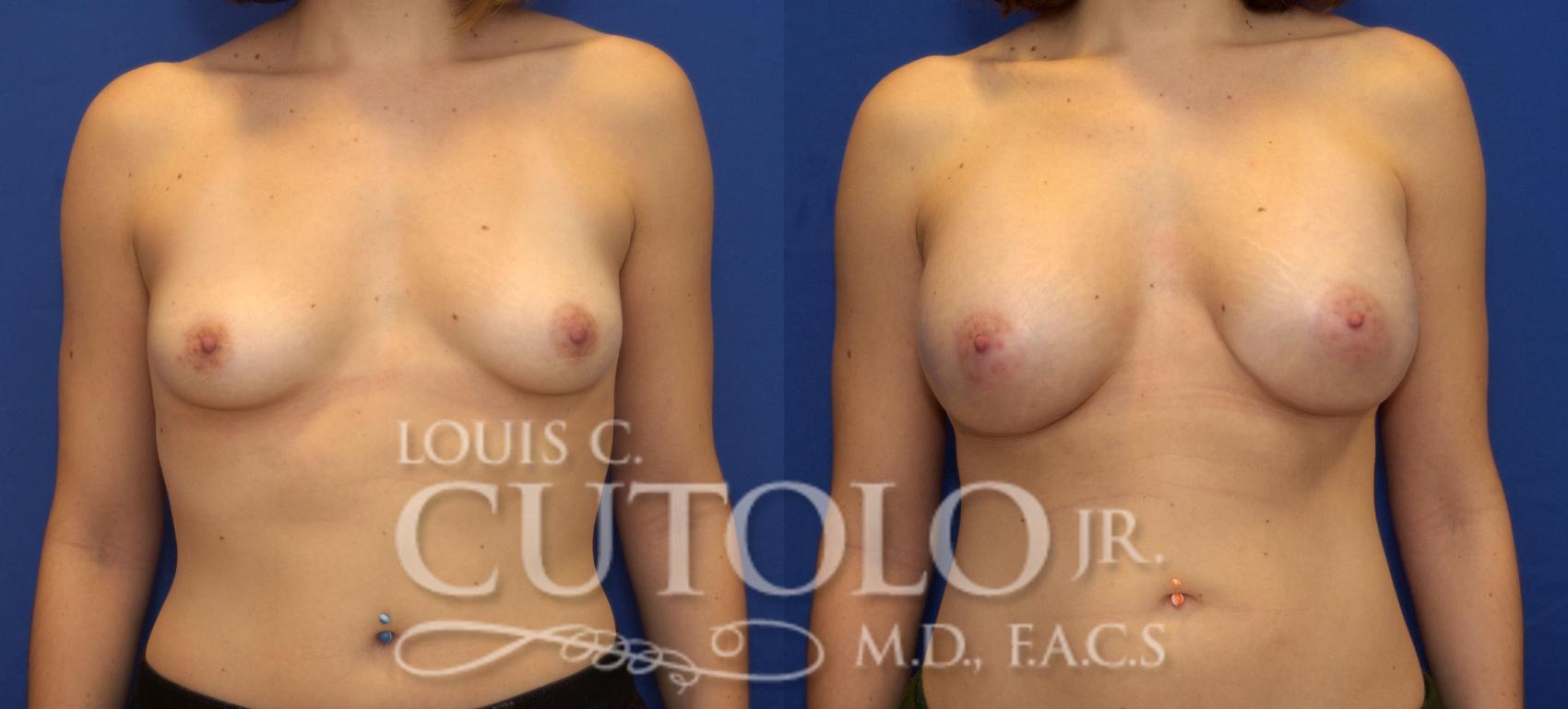 Before & After Breast Augmentation Case 68 View #1 View in Brooklyn, Staten Island, Queens, NY