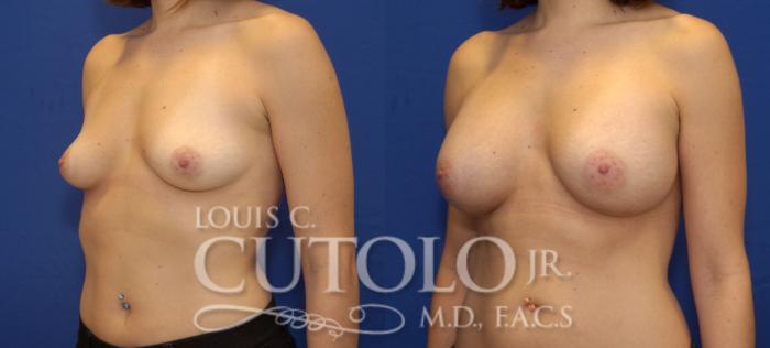 Before & After Breast Augmentation Case 68 View #2 View in Brooklyn, Staten Island, Queens, NY