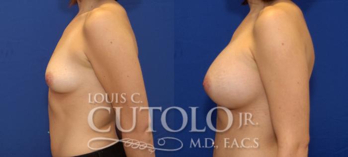 Before & After Breast Augmentation Case 68 View #3 View in Brooklyn, Staten Island, Queens, NY