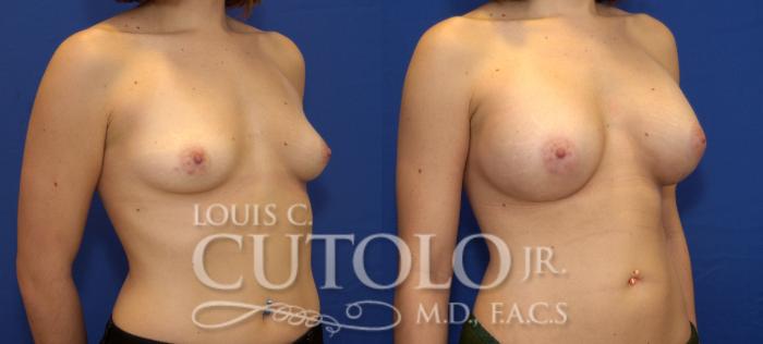 Before & After Breast Augmentation Case 68 View #4 View in Brooklyn, Staten Island, Queens, NY