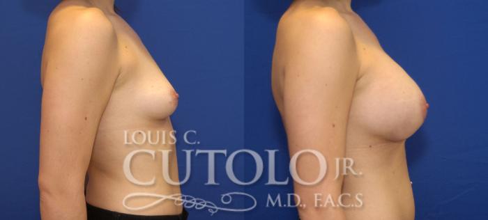 Before & After Breast Augmentation Case 68 View #5 View in Brooklyn, Staten Island, Queens, NY