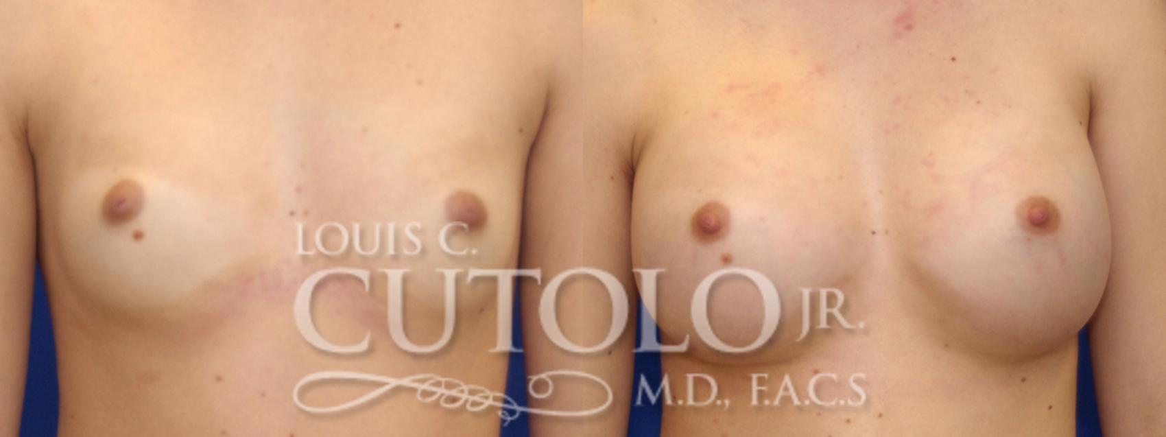 Before & After Breast Augmentation Case 7 View #1 View in Brooklyn, Staten Island, Queens, NY